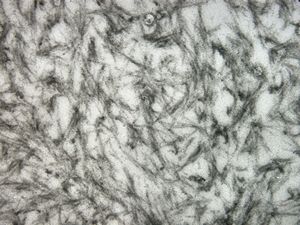 M,56y. | amyloid - tendon M,56y. | amyloid - tendon